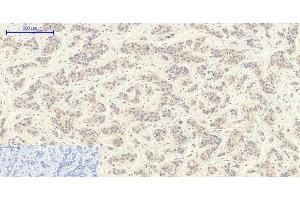 Immunohistochemistry of paraffin-embedded Human liver cancer tissue using TGFB1 Polyclonal Antibody at dilution of 1:200. (TGFB1 anticorps)