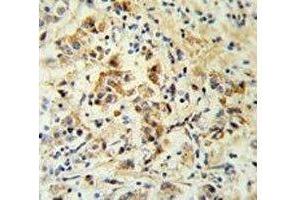 Bid antibody IHC analysis in formalin fixed and paraffin embedded human breast carcinoma. (BID anticorps  (AA 39-68))