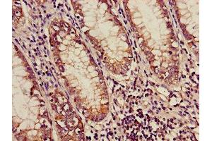 Immunohistochemistry of paraffin-embedded human colon cancer using ABIN7159169 at dilution of 1:100 (Medium-Chain Specific Acyl-CoA Dehydrogenase, Mitochondrial (MCAD) (AA 26-421) anticorps)