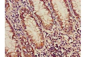 Immunohistochemistry of paraffin-embedded human colon cancer using ABIN7159169 at dilution of 1:100 (Medium-Chain Specific Acyl-CoA Dehydrogenase, Mitochondrial (AA 26-421) anticorps)