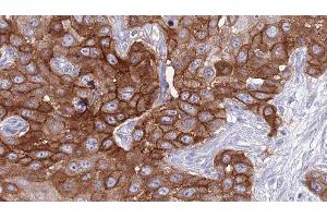 ABIN6277036 at 1/100 staining Human Head and neck cancer tissue by IHC-P. (CD94 anticorps  (C-Term))