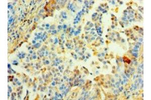 Immunohistochemistry of paraffin-embedded human lung cancer using ABIN7142344 at dilution of 1:100 (MRPL1 anticorps  (AA 51-324))