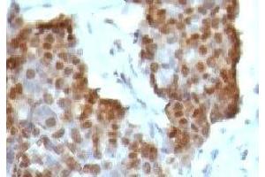 IHC testing of gastric carcinoma stained with Estrogen Receptor beta antibody (ESR2 anticorps  (C-Term))