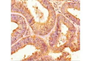 Immunohistochemistry of paraffin-embedded human endometrial cancer using ABIN7166456 at dilution of 1:100