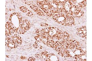 IHC-P Image Immunohistochemical analysis of paraffin-embedded NCI-N87 xenograft, using Citrate synthetase, antibody at 1:500 dilution.