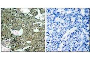 Immunohistochemical analysis of paraffin-embedded human breast carcinoma tissue using MEK1 (phospho- Ser221) antibody (E011161). (MEK1 anticorps  (pSer221))