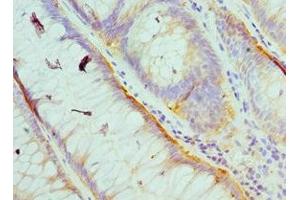 Immunohistochemistry of paraffin-embedded human colon cancer using ABIN7174029 at dilution of 1:100
