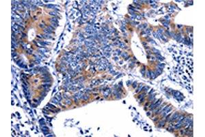 The image on the left is immunohistochemistry of paraffin-embedded Human colon cancer tissue using ABIN7129604(GIP Antibody) at dilution 1/13, on the right is treated with fusion protein.