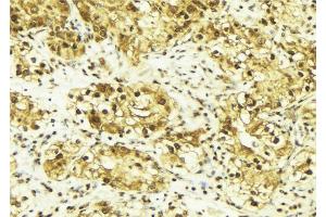 ABIN6269095 at 1/100 staining Human breast cancer tissue by IHC-P. (C-JUN anticorps  (Internal Region))