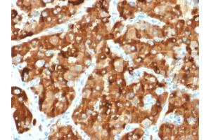 Formalin-fixed, paraffin-embedded human Renal Cell Carcinoma stained with AMACR / p504S Mouse Monoclonal Antibody (AMACR/1864).