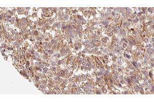 ABIN6279229 at 1/100 staining Human Melanoma tissue by IHC-P. (CALML3 anticorps  (Internal Region))
