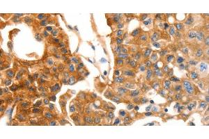 Immunohistochemistry of paraffin-embedded Human lung cancer using MVP Polyclonal Antibody at dilution of 1:30 (MVP anticorps)