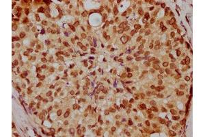 IHC image of ABIN7164247 diluted at 1:200 and staining in paraffin-embedded human breast cancer performed on a Leica BondTM system. (Lamin A/C anticorps  (AA 385-572))