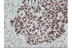 Immunohistochemical staining of paraffin-embedded Carcinoma of Human lung tissue using anti-TP53 mouse monoclonal antibody. (p53 anticorps)