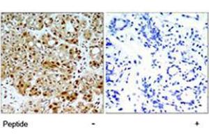 Immunohistochemical analysis of paraffin-embedded human breast carcinoma tissue using HSP90AB1 polyclonal antibody  .