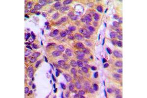 Immunohistochemical analysis of PLC gamma 1 staining in human breast cancer formalin fixed paraffin embedded tissue section.