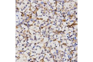 Immunohistochemistry of paraffin-embedded human kidney cancer tissue using CA4 antibody at dilution of 1:200 (x400 lens) (CA4 anticorps)