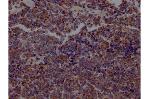 IHC image of ABIN7127319 diluted at 1:100 and staining in paraffin-embedded human lung cancer performed on a Leica BondTM system. (Recombinant ACO2 anticorps)