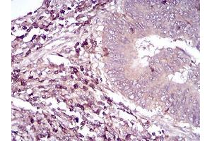 Immunohistochemical analysis of paraffin-embedded rectum cancer tissues using CD6 mouse mAb with DAB staining.