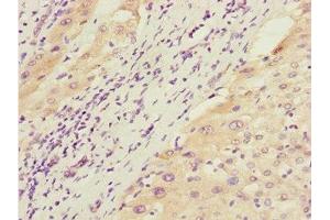 Immunohistochemistry of paraffin-embedded human liver cancer using ABIN7172660 at dilution of 1:100 (GTF2A2 anticorps  (AA 1-109))