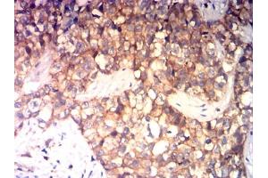 Immunohistochemical analysis of paraffin-embedded bladder cancer tissues using CD99 mouse mAb with DAB staining.