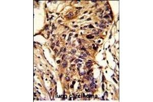 Formalin-fixed and paraffin-embedded human lung carcinoma reacted with BCKDHA Antibody (C-term), which was peroxidase-conjugated to the secondary antibody, followed by DAB staining.