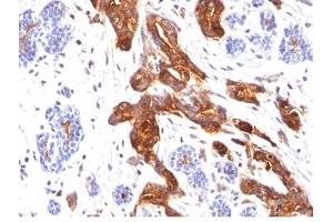 Formalin-fixed, paraffin-embedded human breast carcinoma stained with EMA antibody (MUC1/845). (MUC1 anticorps)