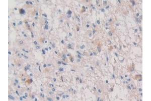 Detection of PALB in Human Glioma Tissue using Polyclonal Antibody to Prealbumin (PALB)