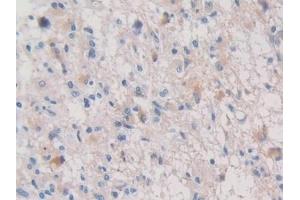 Detection of PALB in Human Glioma Tissue using Polyclonal Antibody to Prealbumin (PALB) (TTR anticorps  (AA 21-147))