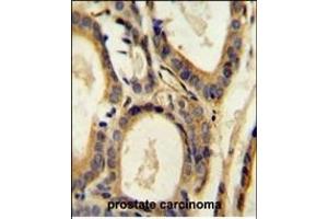 CCL4 Antibody (Center) (ABIN654131 and ABIN2850474) immunohistochemistry analysis in formalin fixed and paraffin embedded human prostate carcinoma followed by peroxidase conjugation of the secondary antibody and DAB staining.