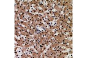 Immunohistochemical analysis of TIP60 staining in human liver cancer formalin fixed paraffin embedded tissue section.