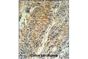 PYCR1 Antibody (C-term) (ABIN653849 and ABIN2843112) IHC analysis in formalin fixed and paraffin embedded colon carcinoma followed by peroxidase conjugation of the secondary antibody and DAB staining. (PYCR1 anticorps  (C-Term))