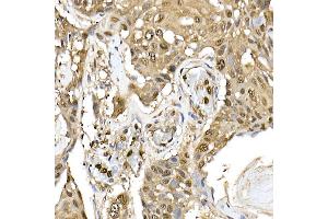 Immunohistochemistry of paraffin-embedded human esophageal cancer using ERK1/2 Rabbit mAb (ABIN7268620) at dilution of 1:100 (40x lens).