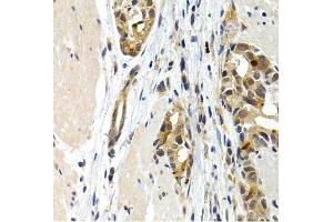 Immunohistochemistry of paraffin-embedded human stomach cancer using IL9 antibody (ABIN3015677, ABIN3015678, ABIN1680463 and ABIN6219030) at dilution of 1:200 (40x lens). (IL-9 anticorps  (AA 19-144))