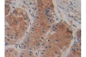 Detection of ABCA1 in Human Stomach cancer Tissue using Polyclonal Antibody to ATP Binding Cassette Transporter A1 (ABCA1)