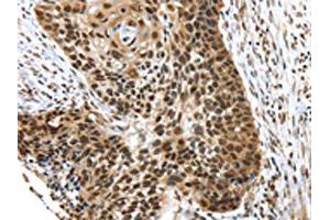 The image on the left is immunohistochemistry of paraffin-embedded Human esophagus cancer tissue using ABIN7192767(TEX37 Antibody) at dilution 1/40, on the right is treated with synthetic peptide. (TEX37 anticorps)