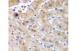 Immunohistochemistry of paraffin-embedded Human liver damage using DPP3 Polyclonal Antibody at dilution of 1:100 (40x lens).