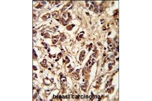 Formalin-fixed and paraffin-embedded human breast carcinoma reacted with PCM-1 Antibody (Center), which was peroxidase-conjugated to the secondary antibody, followed by DAB staining.