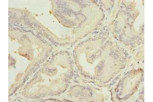 Immunohistochemistry of paraffin-embedded human prostate cancer using ABIN7159116 at dilution of 1:100 (MED18 anticorps  (AA 35-208))