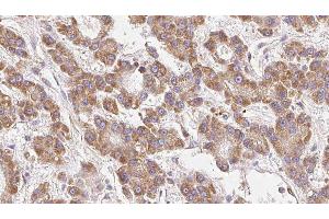 ABIN6279174 at 1/100 staining Human liver cancer tissue by IHC-P. (KCNJ10 anticorps  (Internal Region))