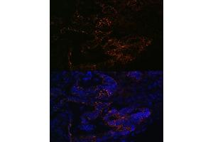 Immunofluorescence analysis of human colon carcinoma using FUT4 Rabbit pAb (ABIN7267274) at dilution of 1:100 (40x lens).