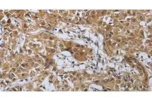 Immunohistochemistry of paraffin-embedded Human lung cancer tissue using PTPRM Polyclonal Antibody at dilution 1:40