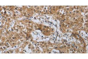 Immunohistochemistry of paraffin-embedded Human lung cancer tissue using PTPRM Polyclonal Antibody at dilution 1:40 (PTPRM anticorps)