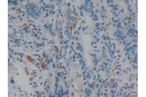 Detection of IBA1 in Human Stomach cancer Tissue using Polyclonal Antibody to Ionized Calcium-binding Adapter Molecule 1 (IBA1)