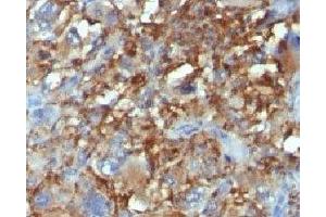 Formalin-fixed, paraffin-embedded human Histiocytoma stained with CD68 antibody. (CD68 anticorps)