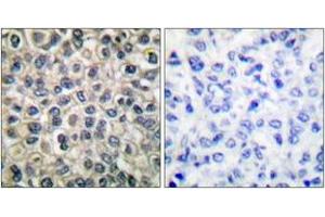Immunohistochemistry analysis of paraffin-embedded human breast carcinoma tissue, using Catenin-gamma Antibody.