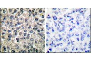 Immunohistochemistry analysis of paraffin-embedded human breast carcinoma tissue, using Catenin-gamma Antibody. (JUP anticorps  (AA 696-745))