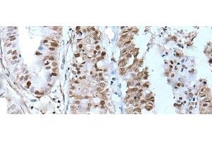 Immunohistochemistry of paraffin-embedded Human liver cancer tissue using ZNHIT3 Polyclonal Antibody at dilution of 1:80(x200) (ZNHIT3 anticorps)
