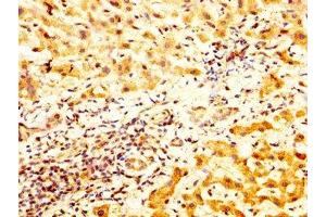 IHC image of ABIN7171412 diluted at 1:800 and staining in paraffin-embedded human liver cancer performed on a Leica BondTM system. (TCP1 alpha/CCTA anticorps  (AA 406-506))