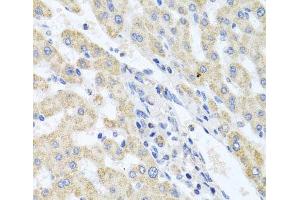 Immunohistochemistry of paraffin-embedded Human liver damage using ITPKB Polyclonal Antibody at dilution of 1:100 (40x lens).